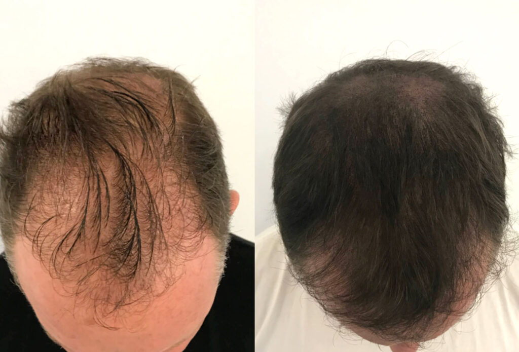 Scalp Micropigmentation Training in Orange County Paris Permanent Makeup Academy